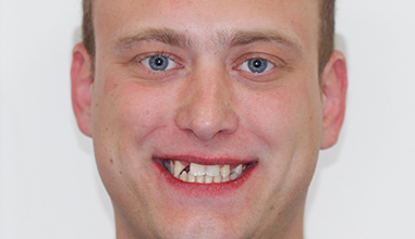 Before - Natural Smiles Implant & Cosmetic Dentistry