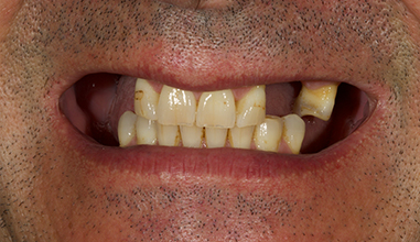 Before - Natural Smiles Implant & Cosmetic Dentistry