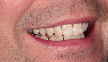 Before - Natural Smiles Implant & Cosmetic Dentistry