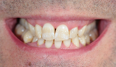 Before - Natural Smiles Implant & Cosmetic Dentistry