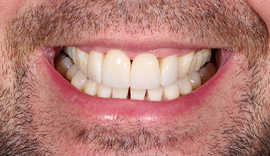 After - Natural Smiles Implant & Cosmetic Dentistry