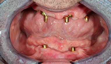 Before - Natural Smiles Implant & Cosmetic Dentistry