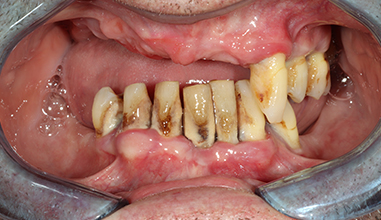 Before - Natural Smiles Implant & Cosmetic Dentistry