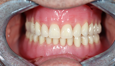 After - Natural Smiles Implant & Cosmetic Dentistry