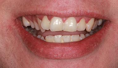 Before - Natural Smiles Implant & Cosmetic Dentistry