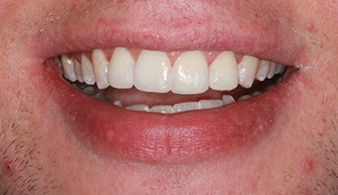 After - Natural Smiles Implant & Cosmetic Dentistry
