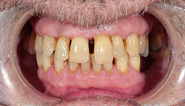 Before - Natural Smiles Implant & Cosmetic Dentistry