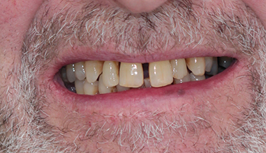 Before - Natural Smiles Implant & Cosmetic Dentistry