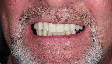 After - Natural Smiles Implant & Cosmetic Dentistry