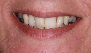 Before - Natural Smiles Implant & Cosmetic Dentistry
