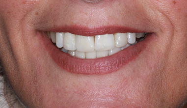 After - Natural Smiles Implant & Cosmetic Dentistry