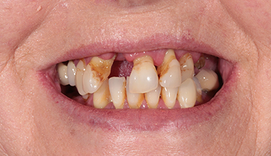 Before - Natural Smiles Implant & Cosmetic Dentistry