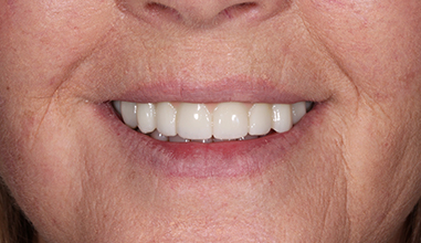 After - Natural Smiles Implant & Cosmetic Dentistry