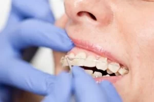 Cost of Ceramic Braces