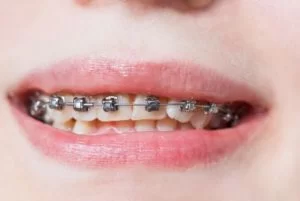 Cost of Damon Braces