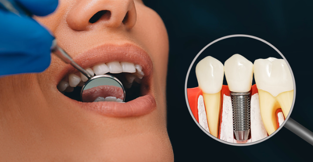 During the Dental Implant Procedure