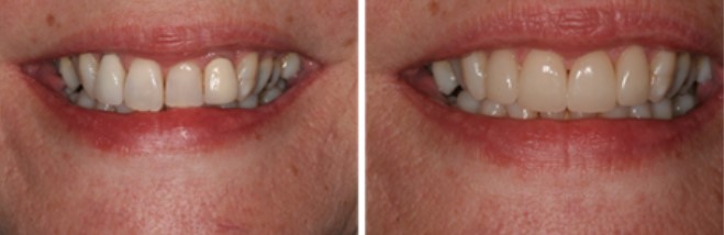 Invisalign Braces before after