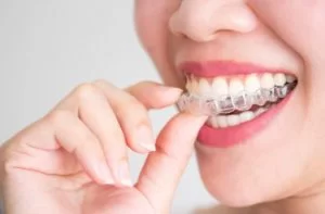 Invisalign Lite Invisible Braces