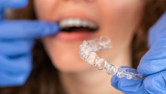 Invisalign Refinement Process