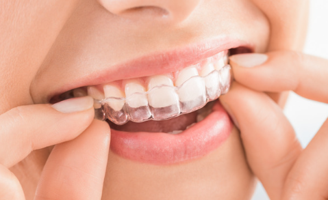 Is Invisalign effective