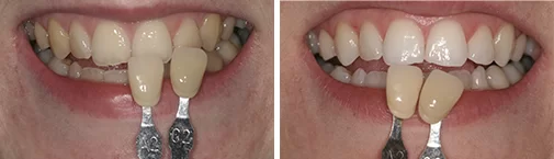Teeth whitening treatment
