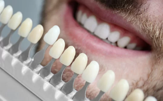 Veneers cost based on number