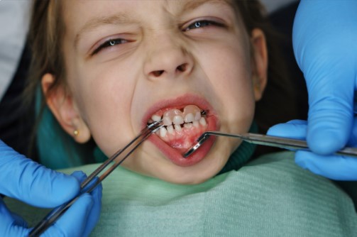 What Is Denture Stomatitis & How Is It Treated