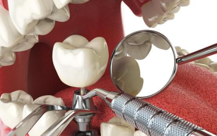 What are dental implants