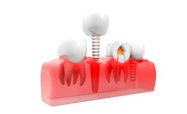Why might a bone graft be necessary for dental implants