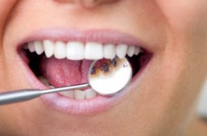 cost for Lingual Braces