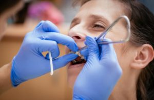 cost of Smart Bracket Braces