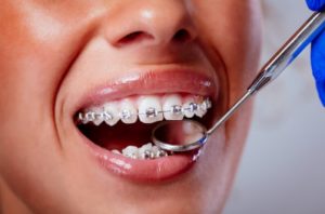 cost of metal braces