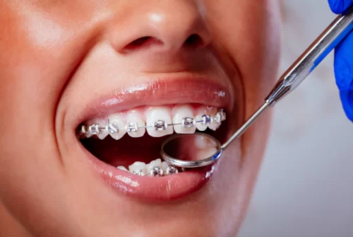 chrome denture cost in UK