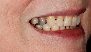 Before - Natural Smiles Implant & Cosmetic Dentistry