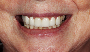 After - Natural Smiles Implant & Cosmetic Dentistry
