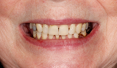 Before - Natural Smiles Implant & Cosmetic Dentistry
