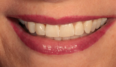 After - Natural Smiles Implant & Cosmetic Dentistry