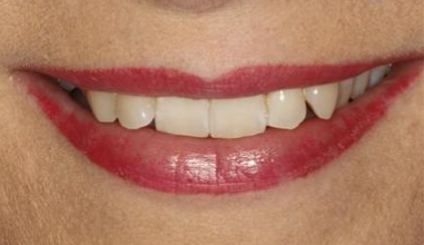 Before - Natural Smiles Implant & Cosmetic Dentistry