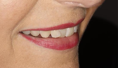 Before - Natural Smiles Implant & Cosmetic Dentistry