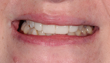 After - Natural Smiles Implant & Cosmetic Dentistry