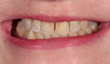 Before - Natural Smiles Implant & Cosmetic Dentistry