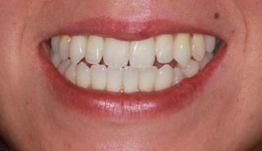 After - Natural Smiles Implant & Cosmetic Dentistry