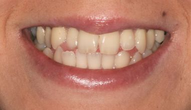 Before - Natural Smiles Implant & Cosmetic Dentistry