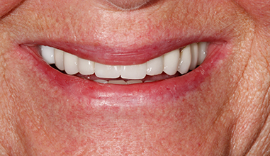 After - Natural Smiles Implant & Cosmetic Dentistry
