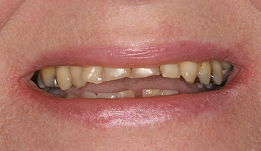 Before - Natural Smiles Implant & Cosmetic Dentistry