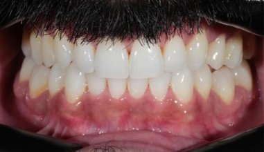 After - Natural Smiles Implant & Cosmetic Dentistry