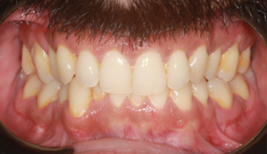 Before - Natural Smiles Implant & Cosmetic Dentistry