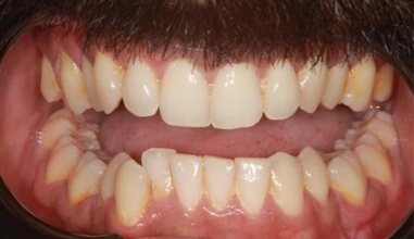 Before - Natural Smiles Implant & Cosmetic Dentistry