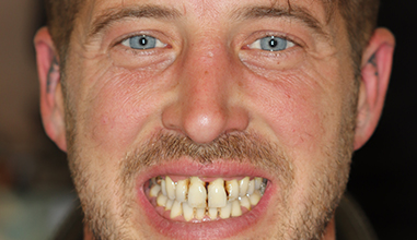 Before - Natural Smiles Implant & Cosmetic Dentistry