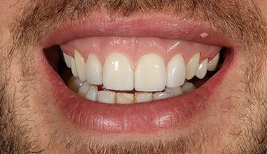 After - Natural Smiles Implant & Cosmetic Dentistry